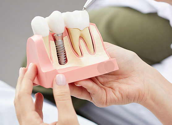 Model of a dental implant