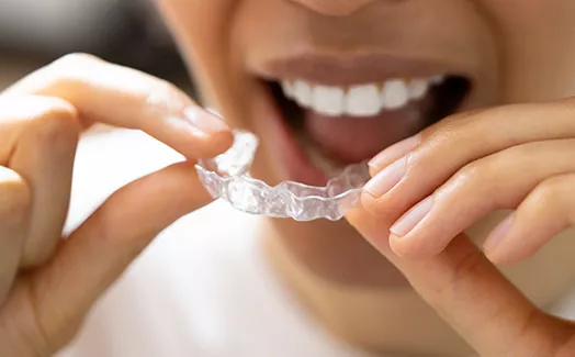 Woman inserting Invisalign clear aligner